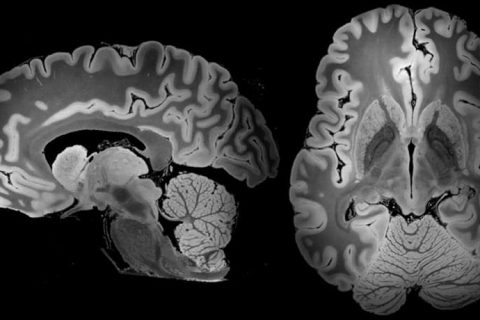 MRI-Scan-of-the-Brain